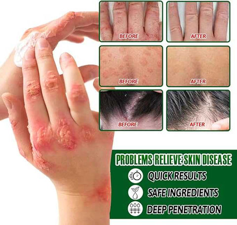 Psoriasis Cream - Herbal Plant Extracts