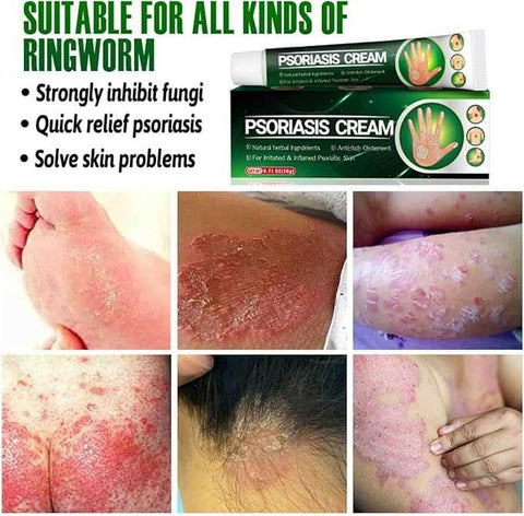 Psoriasis Cream - Herbal Plant Extracts